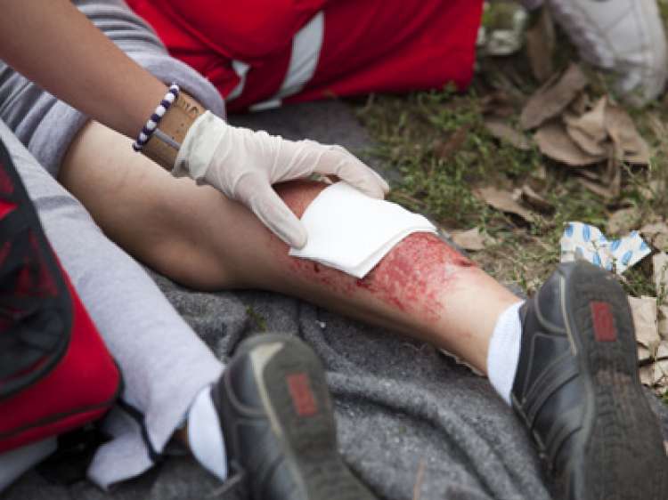 Severe Burn Injury Accident Lawyers